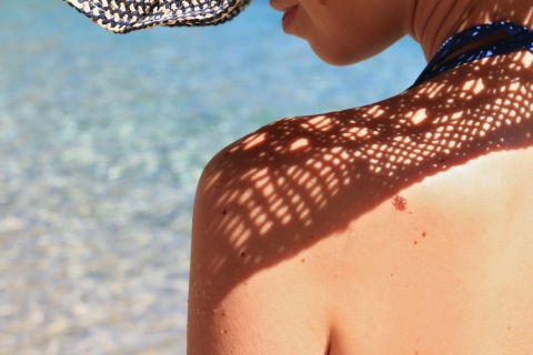 Woman wearing hat in bikini at the beach in the sun. Skin is tanned with moles.