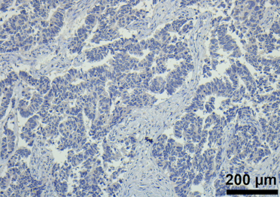 Low ROR1 staining in endometrial cancer