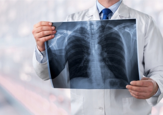 A doctor holds a chest radiograph of someone's lungs