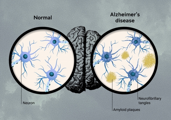 Amyloid plaques and neurofibrillary tangles in Alzheimer's disease