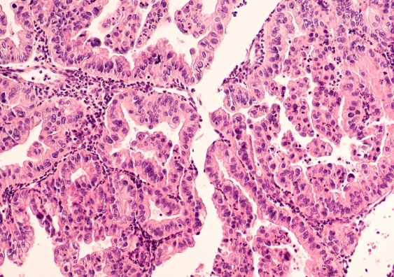 Micrograph of a serous papillary carcinoma (adenocarcinoma) of ovary. Image: Shutterstock