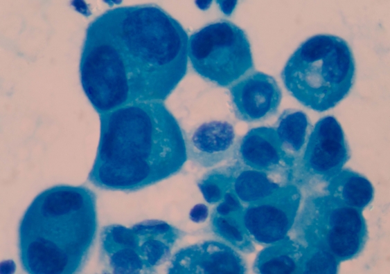 Cancer cells. Photo: Shutterstock