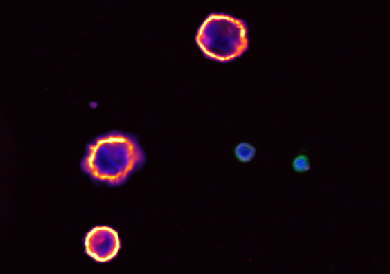 Microscope image of circulating tumour cells (which are coloured red and purple) isolated from a blood sample. Image: Dr John Lock and Associate Professor Therese Becker.