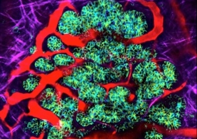 A glow-in-the-dark breast tumour (green, blue and yellow) in living tissue, fed by blood vessels (red) and surrounded by dense collagen matrix (purple). Image: Garvan Institute