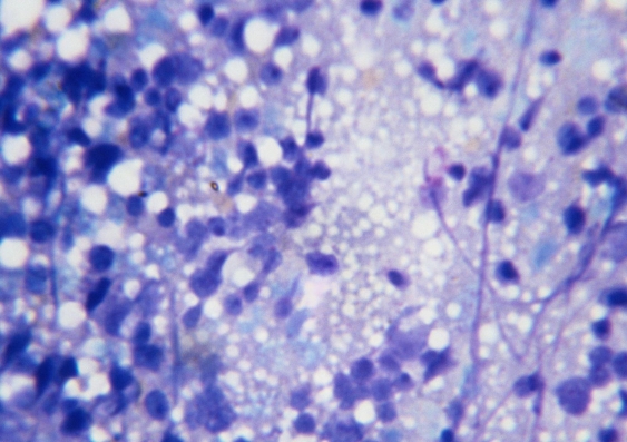 Microscopic image of bone marrow cells dividing (Photo: Thinkstock)