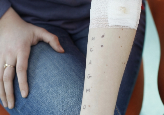 Patients can undergo allergy testing, which includes skin testing (pictured above), to determine whether they are truly allergic to penicillin. Photo: BSIP / Getty Images.