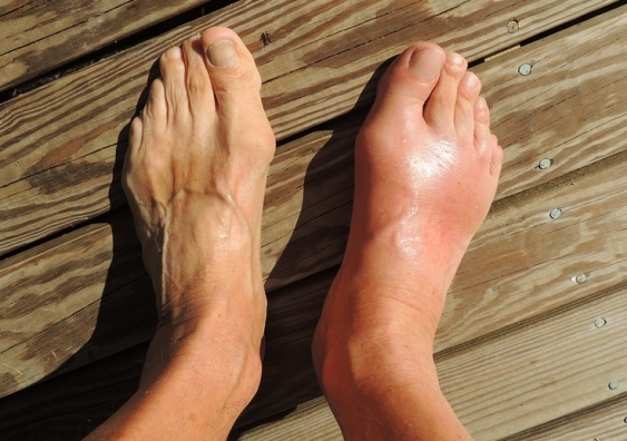 Gout is a common and painful inflammatory arthritis that is caused by deposits of uric acid in the joints. Photo: Pixabay