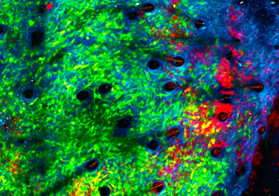 When exposed to bacteria, neutrophils (red) began attacking cancer cells (green) in the collagen structure (blue) of a tumour’s microenvironment. Image credit: Jacqueline Bailey, Dr Chtanova’s Innate Tumour Immunology Lab, Garvan