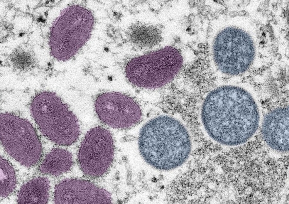 Micrograph of the monkeypox viral particles that cause the monkeypox disease. Image: US Centers for Disease Control