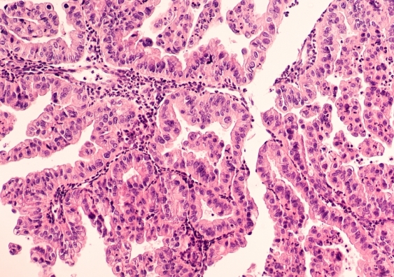 The new test is designed to analyse and classify high-grade serous ovarian cancer, the most common and lethal form of ovarian cancer. Image: Shutterstock