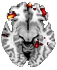 MRI scan of brain showing blood flow