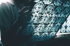 An MRI of Alzheimer's Disease