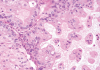 Mucinous ovarian cancer cells