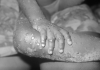 A person infected with monkeypox with welts on their hand and leg