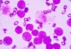 Blood smear under microscopy showing on Adult acute myeloid leukemia (AML) is a type of cancer in which the bone marrow makes abnormal myeloblasts a type of white blood cell.