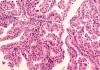 Micrograph of a serous papillary carcinoma (adenocarcinoma) of ovary