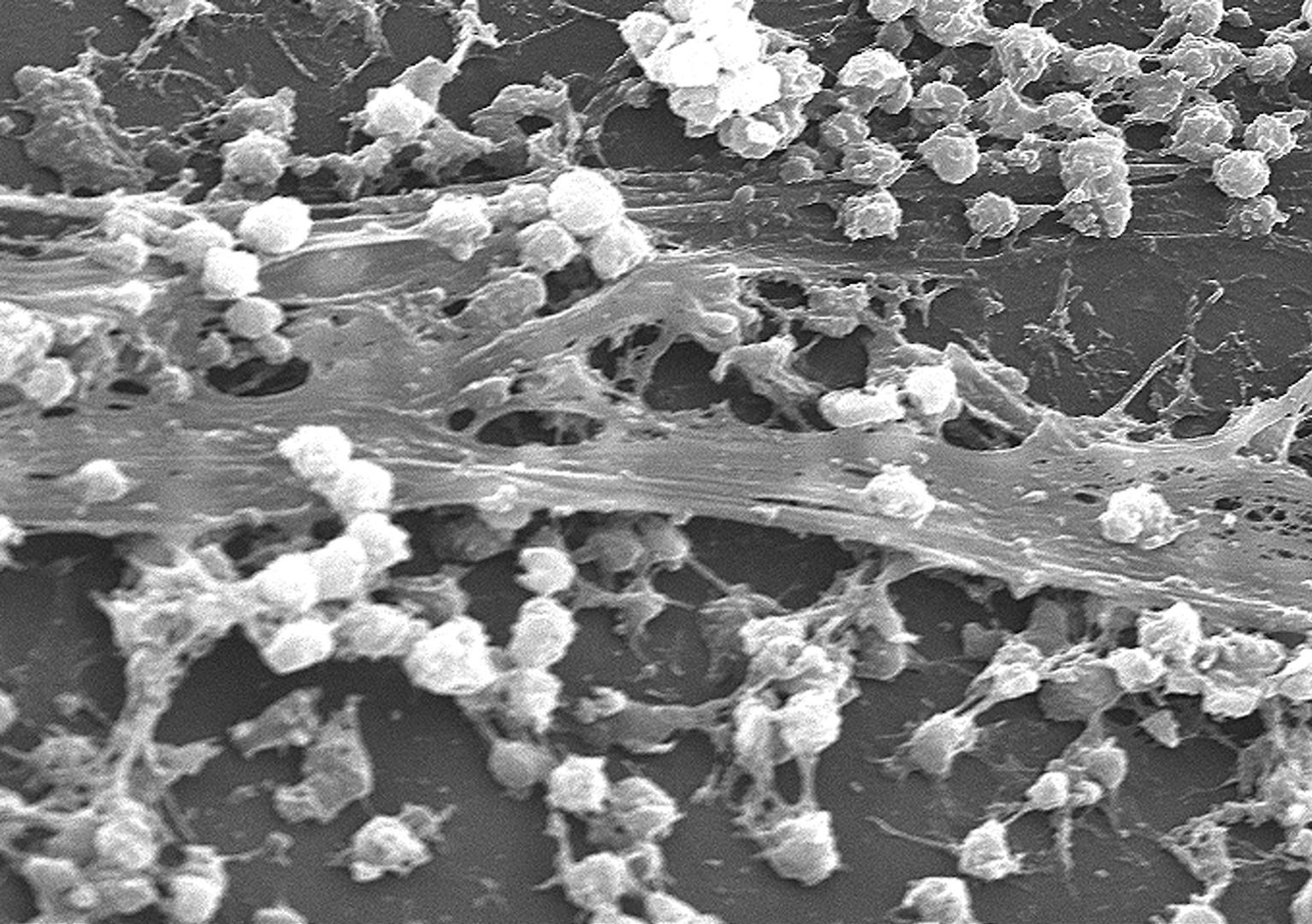 Staphylococcus aureus bacterial biofilm on an indwelling catheter.