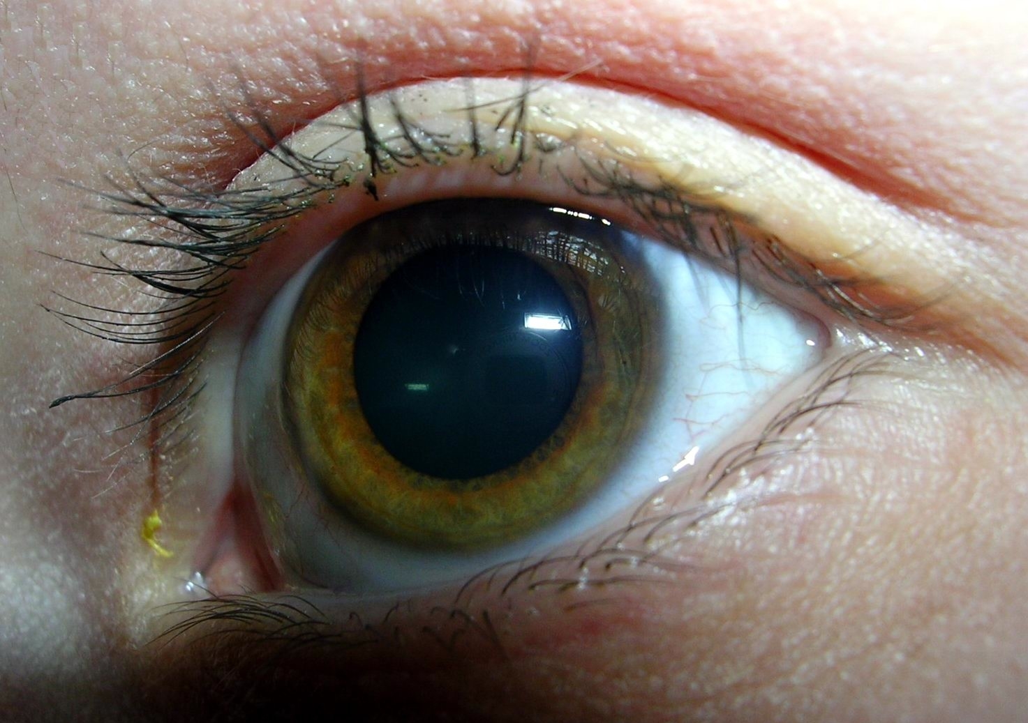 Пелена на глазах какие. Неоваскулярная глаукома.